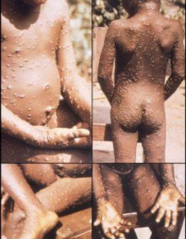 Monkeypox primarily spread via sexual contact, but containable: WHO. The current outbreak of the monkeypox virus is primarily spreading through sex among men, the World Health Organization (WHO) has said,