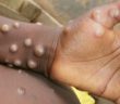 Monkeypox spreads to more European countries, Australia, Canada. Italy, Sweden, Australia and Canada have joined a slew of countries with confirmed cases of