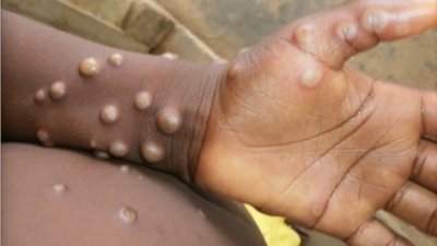 Monkeypox spreads to more European countries, Australia, Canada. Italy, Sweden, Australia and Canada have joined a slew of countries with confirmed cases of